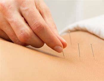 Acupuncture price