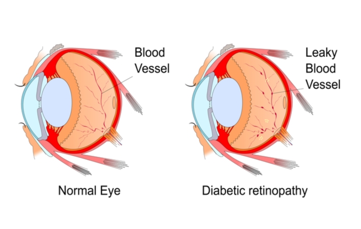 diabetic-retinopathy-diagram