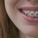 Self-Ligating Braces
