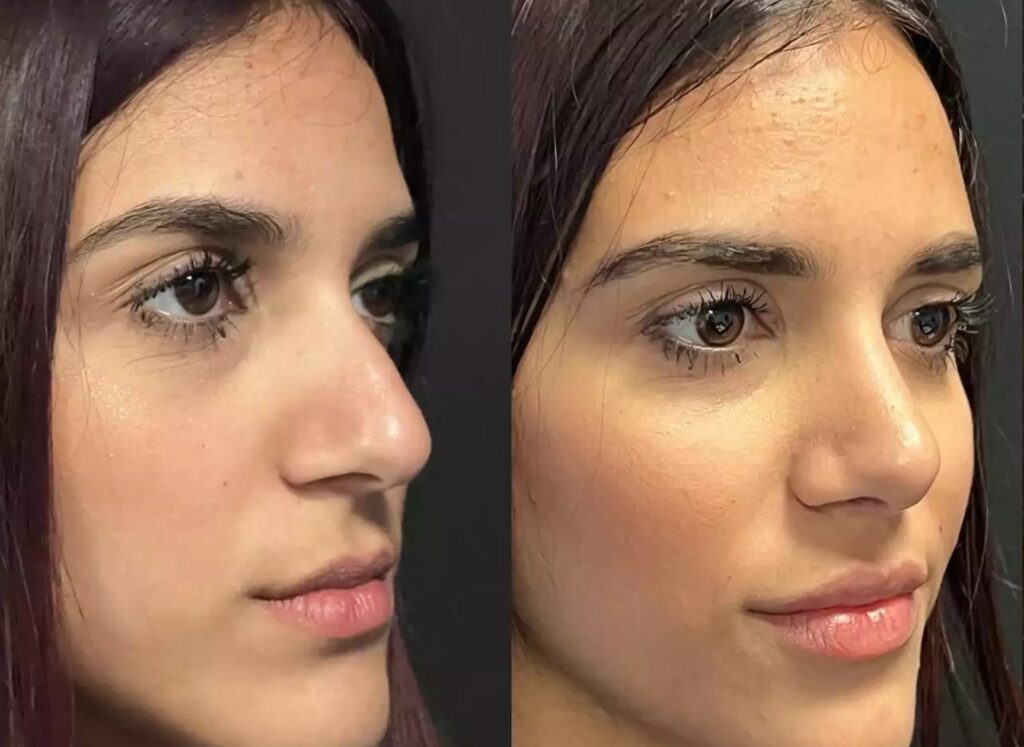 H-Rhinoplasty-11