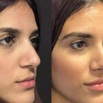 H-Rhinoplasty-11