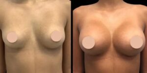 Breast Augmentation in Dubai: Silicone vs. Saline Implants Explained