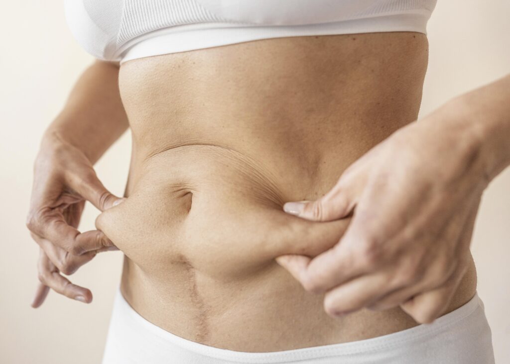 Liposuction in Dubai
