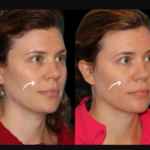 sculptra fillers in dubai
