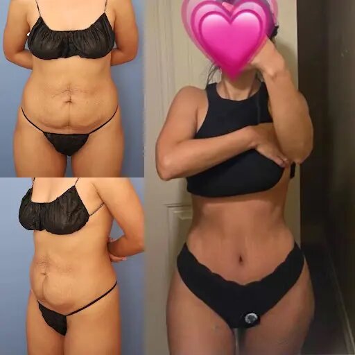 tummy-tuck-before-and-after