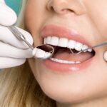 How to Care for Your Veneers Dubai for a Lasting Smile