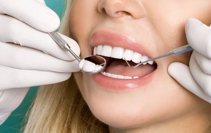 How to Care for Your Veneers Dubai for a Lasting Smile