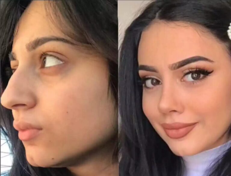 septoplasty in dubai