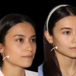 sculptra fillers