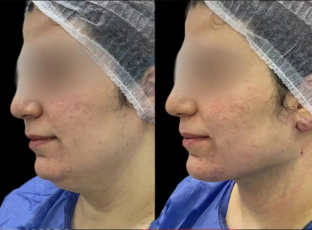 H13-Chin-Fillers (1)