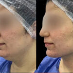 H13-Chin-Fillers (1)