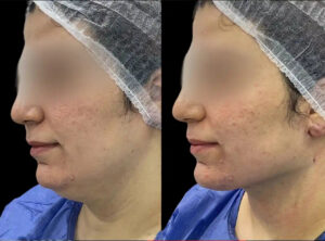 H13-Chin-Fillers (1)