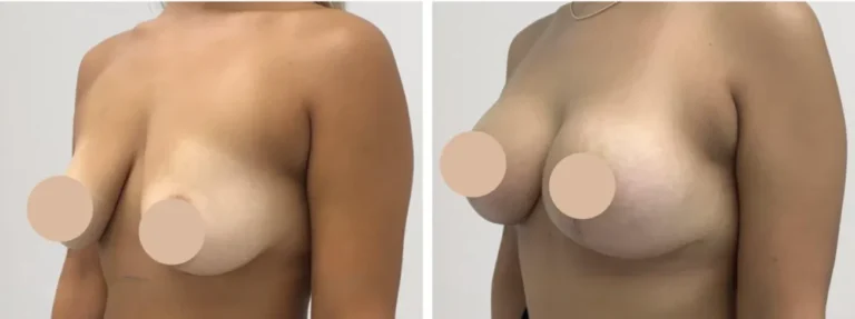 breast reduction in dubai