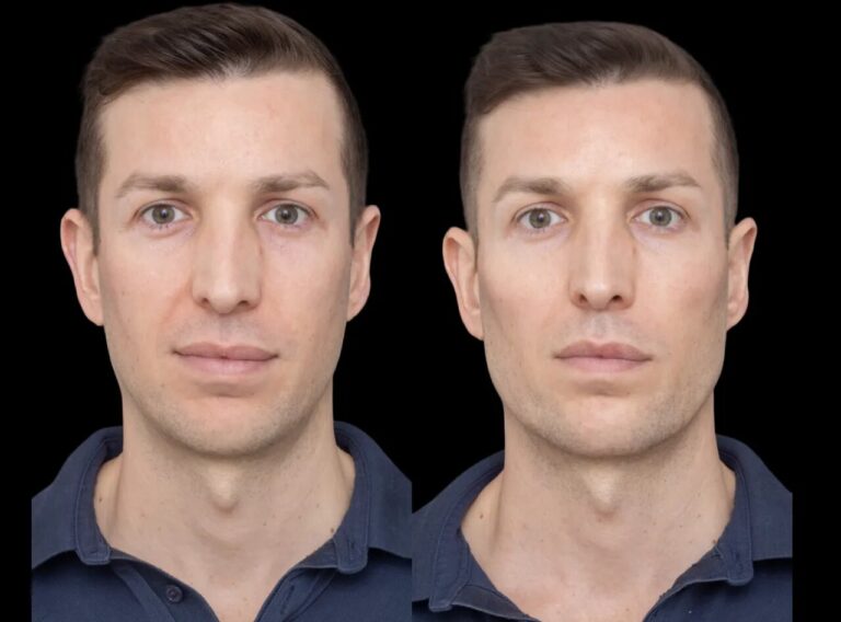 H2-Cheek-Fillers