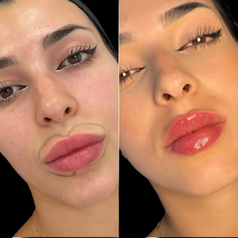 fillers in dubai
