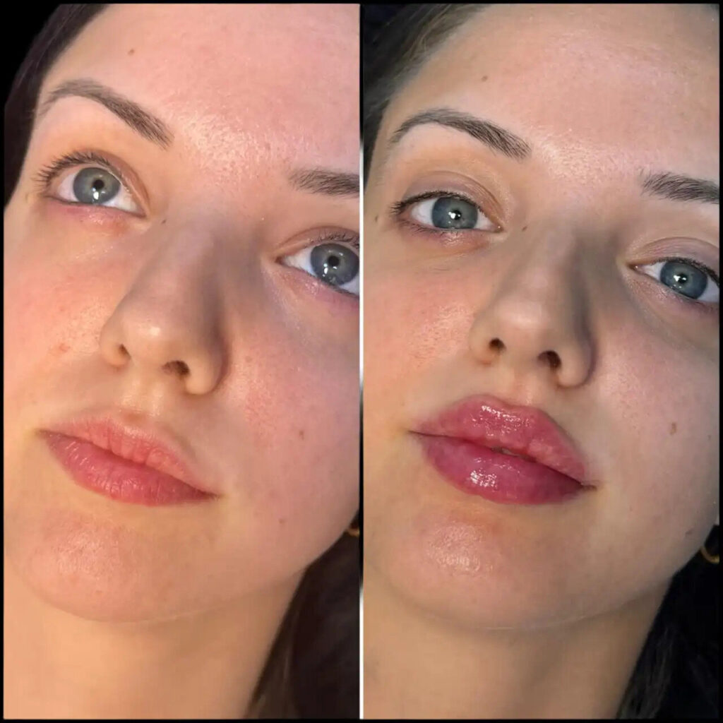 H5-lip-fillers (1) (1)