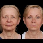 H7-Under-eye-fillers