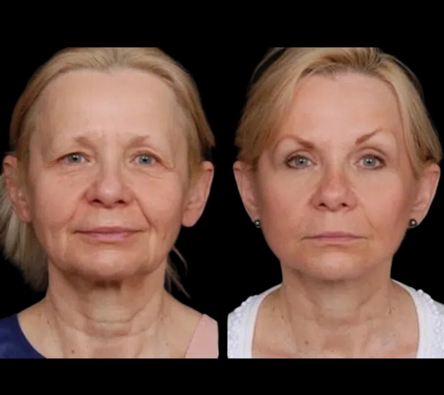 H7-Under-eye-fillers