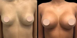 Why the Best Doctors in Dubai Recommend Breast Augmentation for Enhancing Your Shape