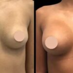 The Benefits of Butt Fat Transfer Surgery in Dubai for a Natural Lift