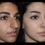 How the Best Rhinoplasty Surgeon in Dubai Uses 3D Imaging for Precision