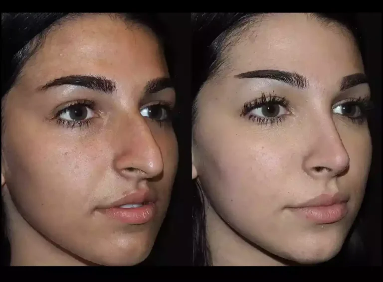 How the Best Rhinoplasty Surgeon in Dubai Uses 3D Imaging for Precision