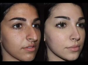 septoplasty in dubai