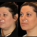 Sculptra Fillers Treatment in Dubai