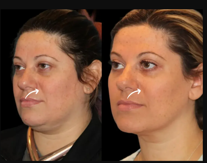 Sculptra Fillers Treatment in Dubai