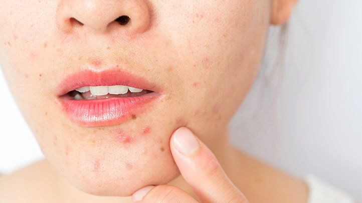 What Acne Treatment Works During Pregnancy?