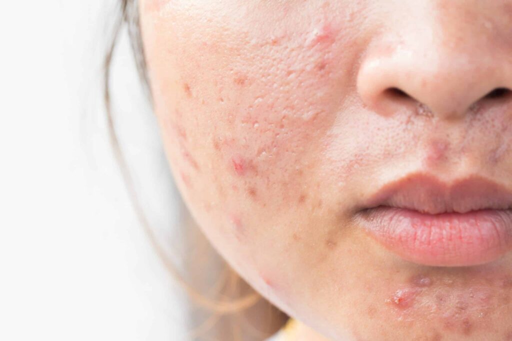 What Works Best for Deep Acne Scar Treatment?