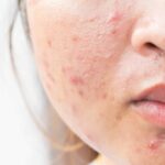 What Works Best for Deep Acne Scar Treatment?