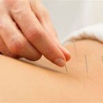 Acupuncture price