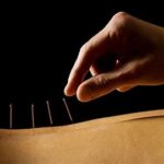 acupuncture for fertility