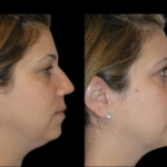 Double chin removal