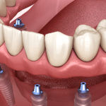 dental implant cost crawfordville fl