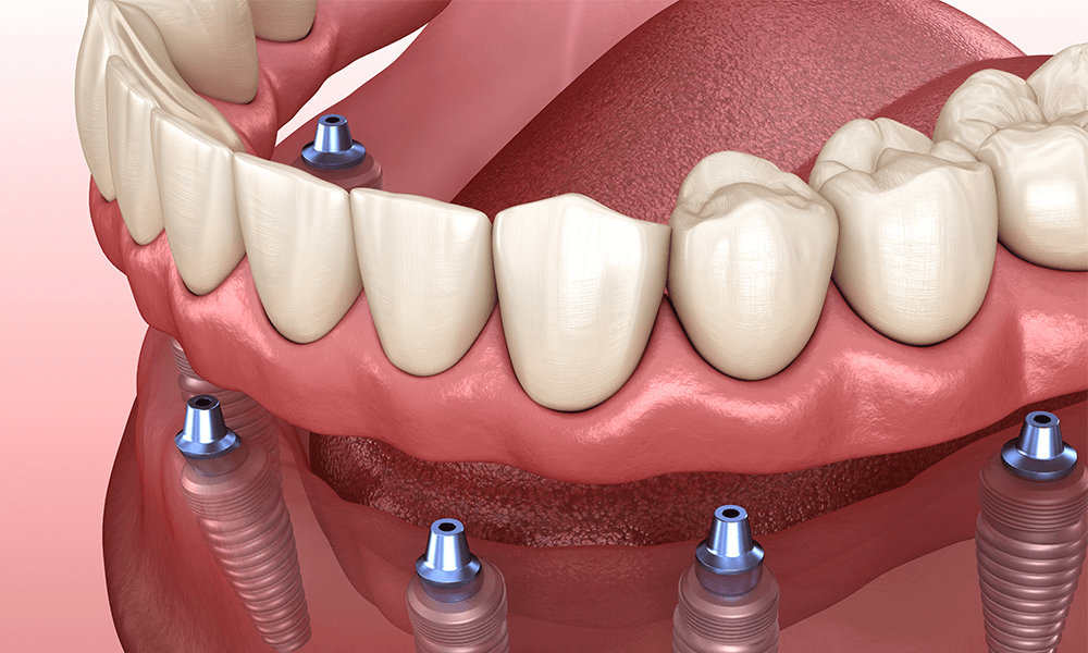 dental implant cost crawfordville fl