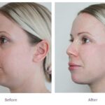 dermal-fillers-full-face-rejuvenation-before-after (1)