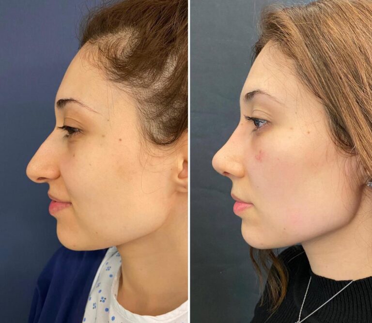 How Fat Transfer Surgery in Dubai Enhances Facial Aesthetics