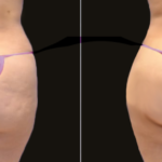The Benefits of Butt Fat Transfer Surgery in Dubai for a Natural Lift