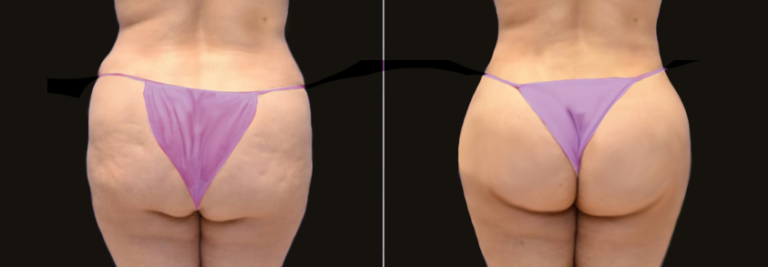 The Benefits of Butt Fat Transfer Surgery in Dubai for a Natural Lift
