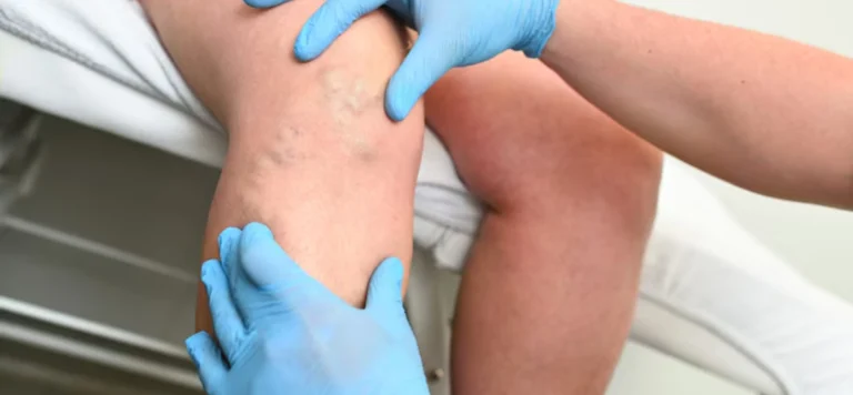 Vein Clinic Near Me