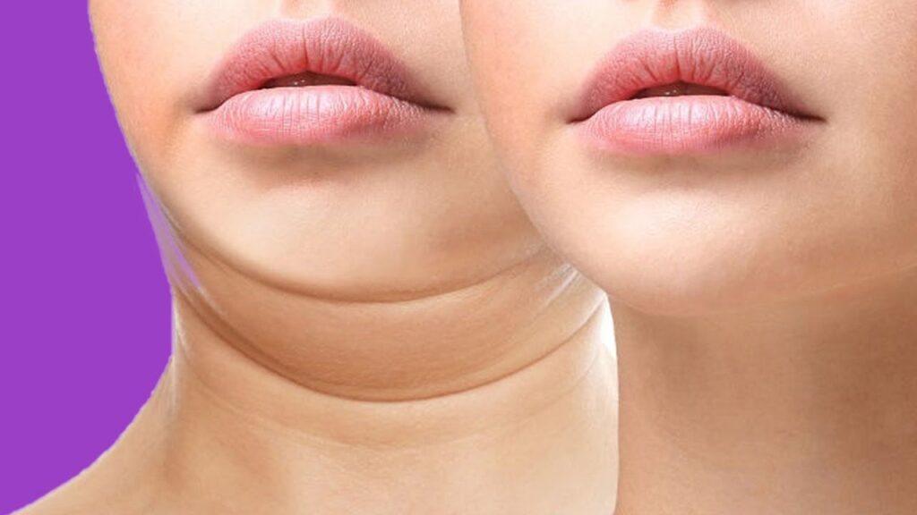 how to get rid of double chin overnight