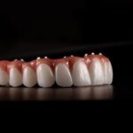 Smilo Dental Implants