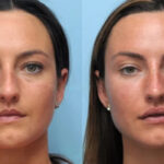 Thread Lift Treatment in Dubai: The Celebrity Secret to Ageless Beauty