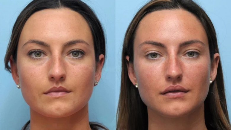 Thread Lift Treatment in Dubai: The Celebrity Secret to Ageless Beauty