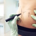 tummy tuck
