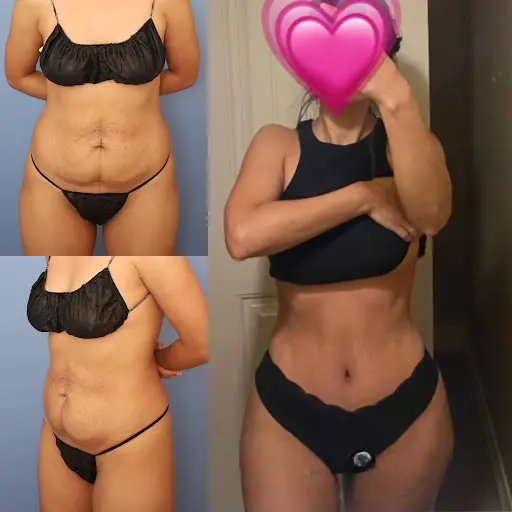 Best Tummy Tuck Surgeon in Dubai