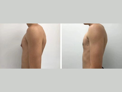 gynecomastia surgery