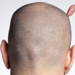 زراعة الشعر في دبي